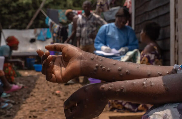 RDC / Urgence Sanitaire : Appel à la population pour renforcer les mesures d’hygiène Face à la résurgence de la Mpox.